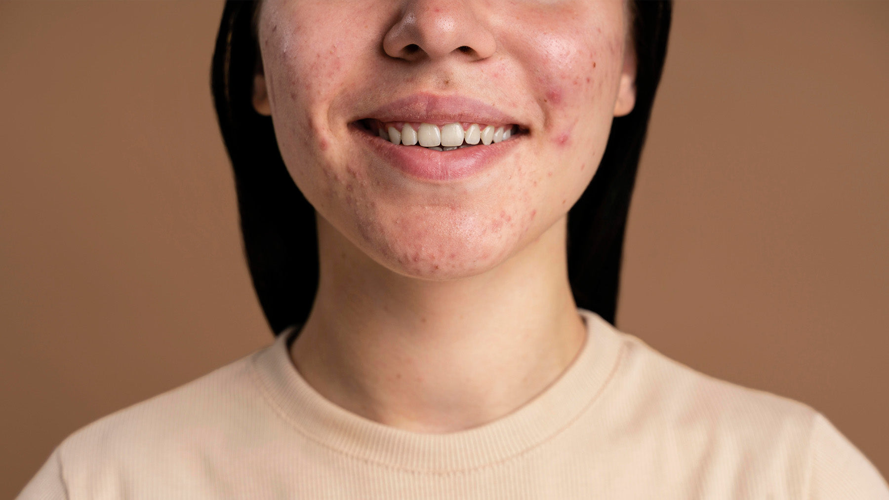 Post-Acne Scars & Hyperpigmentation: How to Fade Dark Marks Safely